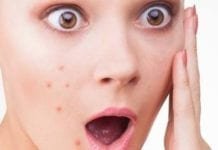 Rahasia dan Fakta Tentang Jerawat yang Bikin Kamu Jadi Sebel Ketika Bercermin